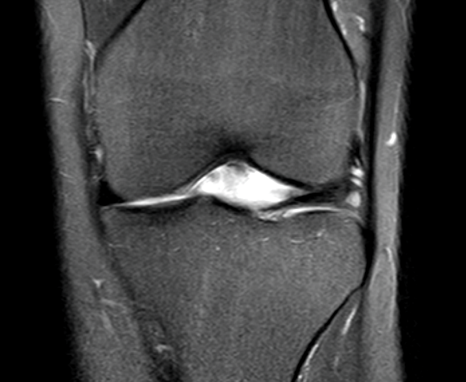 Meniskus gerissen MRT? (Knie, MRT Befund, Radiologie)