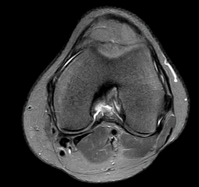 Meniskus gerissen MRT? (Knie, MRT Befund, Radiologie) Meniskus gerissen MRT? (Knie, MRT Befund, Radiologie)