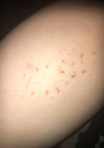Merkwürdige Flecken auf der Haut?