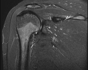 abnehmen bei arthrose