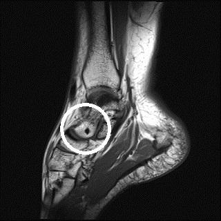 Mrt Aufnahme Vom Sprungelenk Schwarzer Fleck Im Knochen Was Kann Das Sein Sprunggelenk Mrt Aufnahme Vom Sprungelenk Schwarzer Fleck Im Knochen Was Kann Das Sein Sprunggelenk