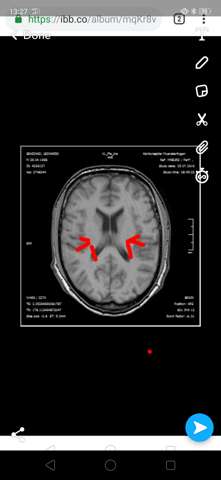 Mrt Befund Angst Gesundheit Neurologie Gehirn Mrt Befund Angst Gesundheit Neurologie Gehirn