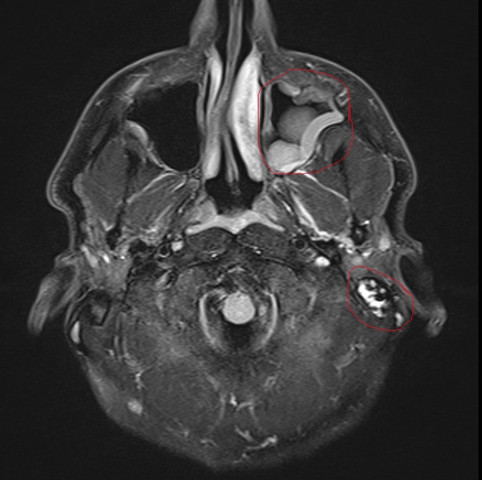 Bild 1 MRT mit Markierung Nebenhöle und Ohr - (Ohr, MRT, Kopf)