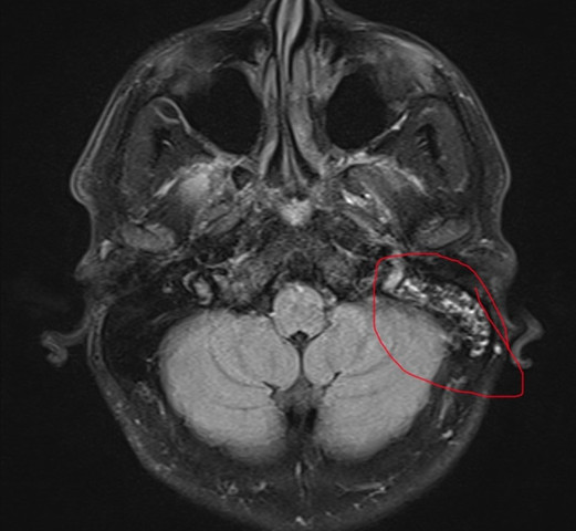 Bild 3 MRT mit Markierung Nebenhöle und Ohr - (Ohr, MRT, Kopf)