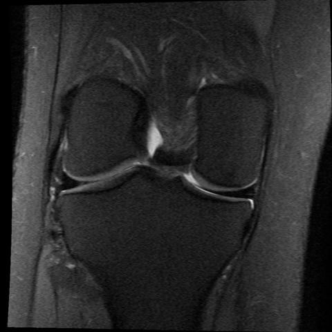 Mrt knie - (Knie, Orthopädie, MRT)