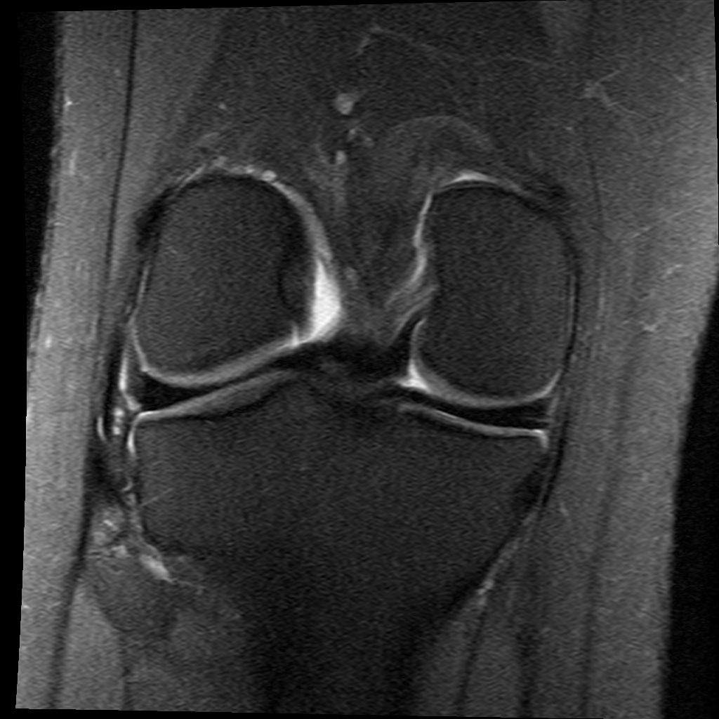 Mrt Bilder Meniskusriss? (Knie, Orthopädie, Chirurgie)