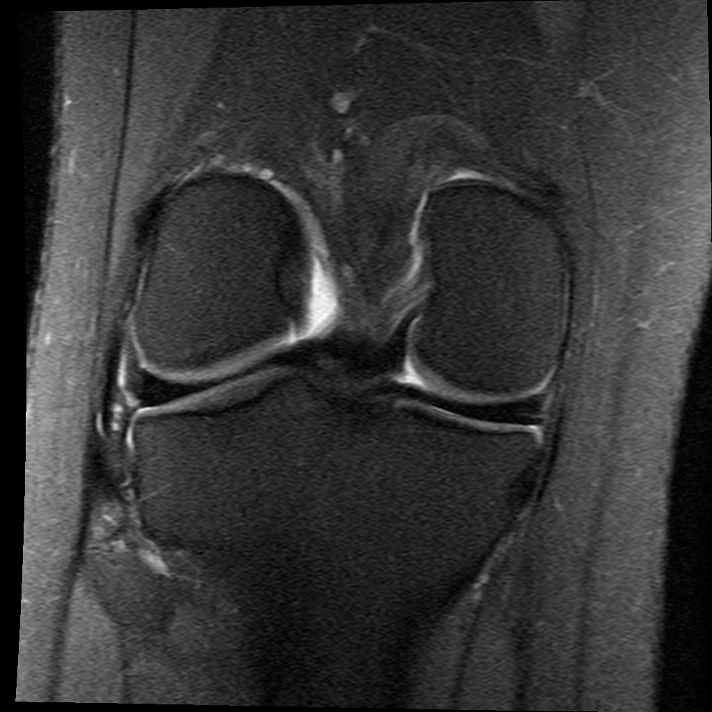 32++ Mrt bilder knie meniskusschaden , Mrt Bilder Meniskusriss? (Knie, Orthopädie, Chirurgie)