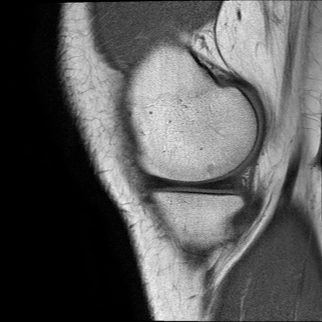 Mrt Bilder - Meniskusriss? (Knie, Orthopädie, Chirurgie)