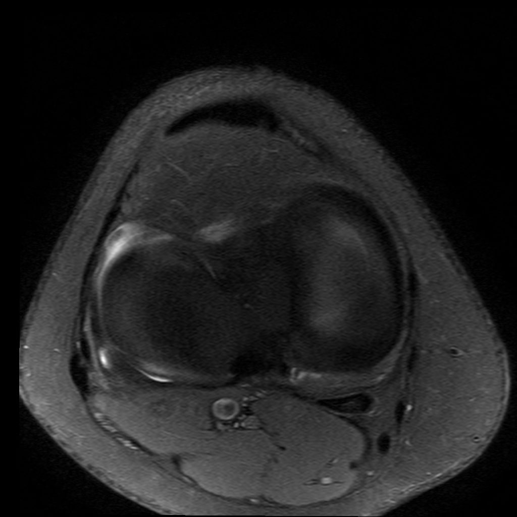 Mrt Bilder - Meniskusriss? (Knie, Orthopädie, Chirurgie)