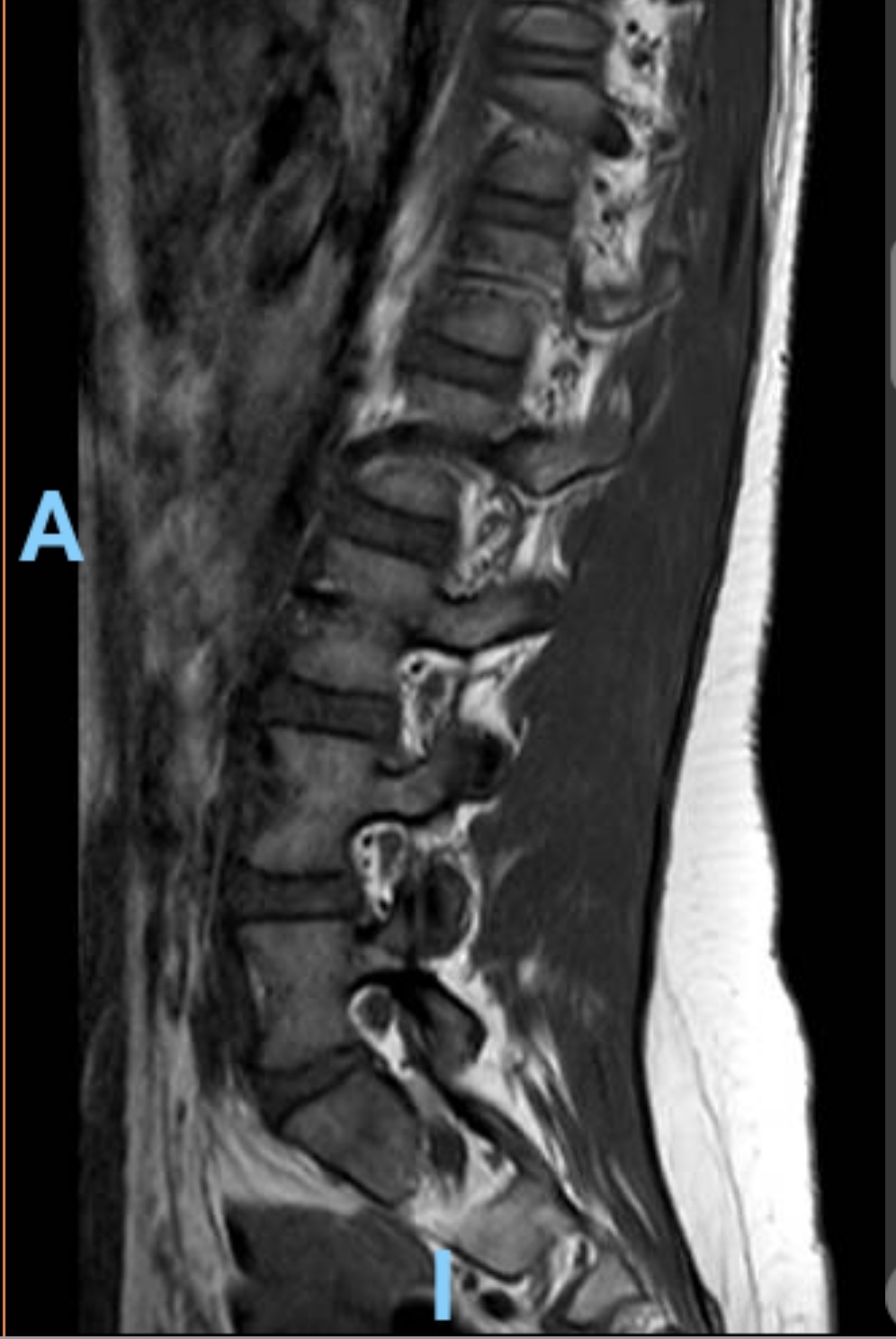 MRT Bilder LWS erste Einschätzung? MRT Bilder LWS erste Einschätzung?