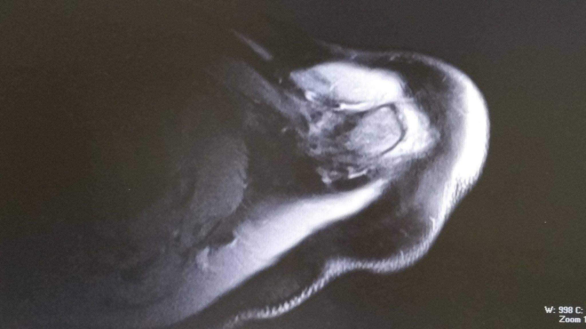 MRT Bilder meiner Schulter , ich bitte um Aufklärung ? (Schultergelenk)