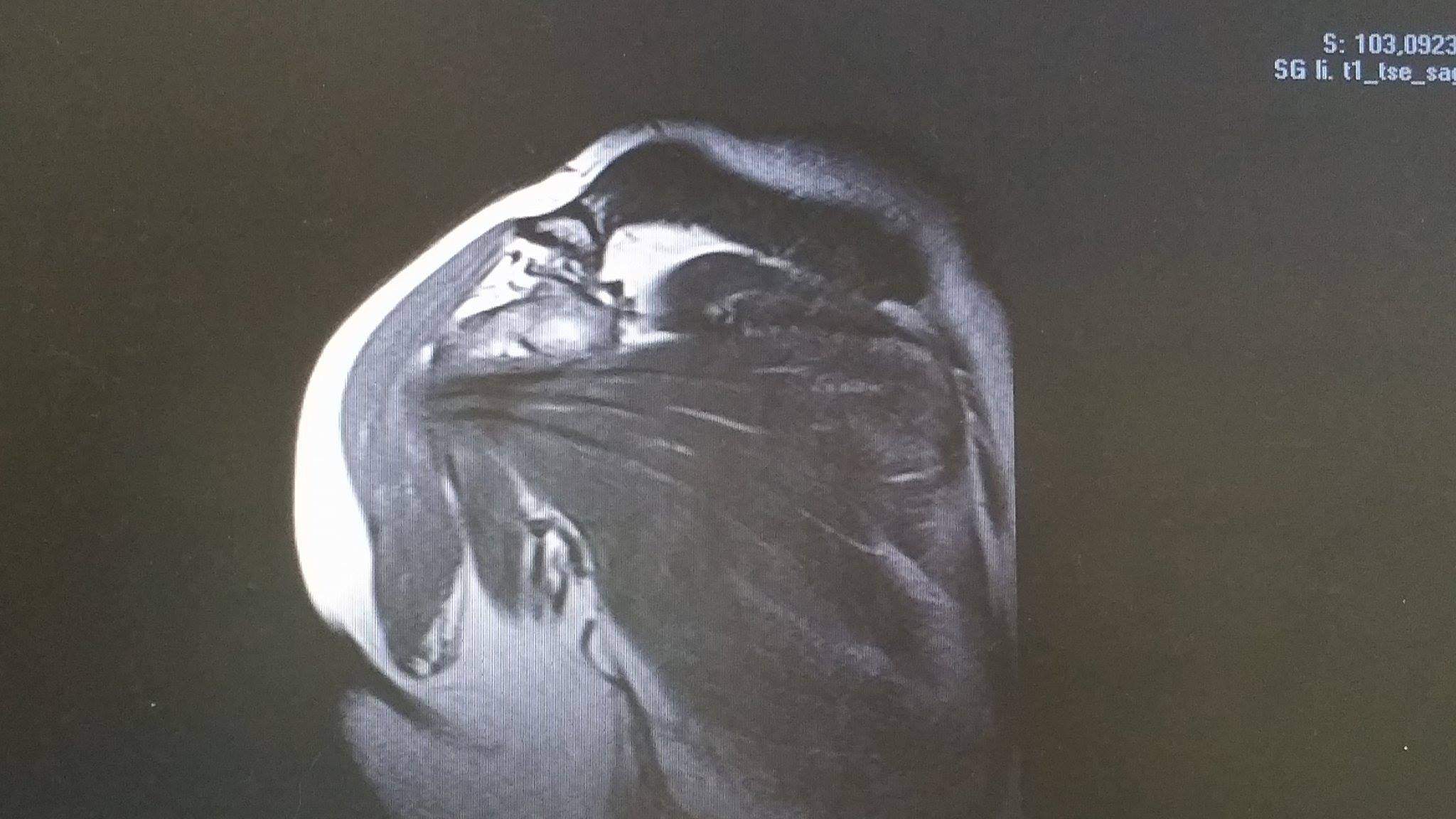 MRT Bilder meiner Schulter , ich bitte um Aufklärung ? (Schultergelenk) MRT Bilder meiner Schulter , ich bitte um Aufklärung ? (Schultergelenk)