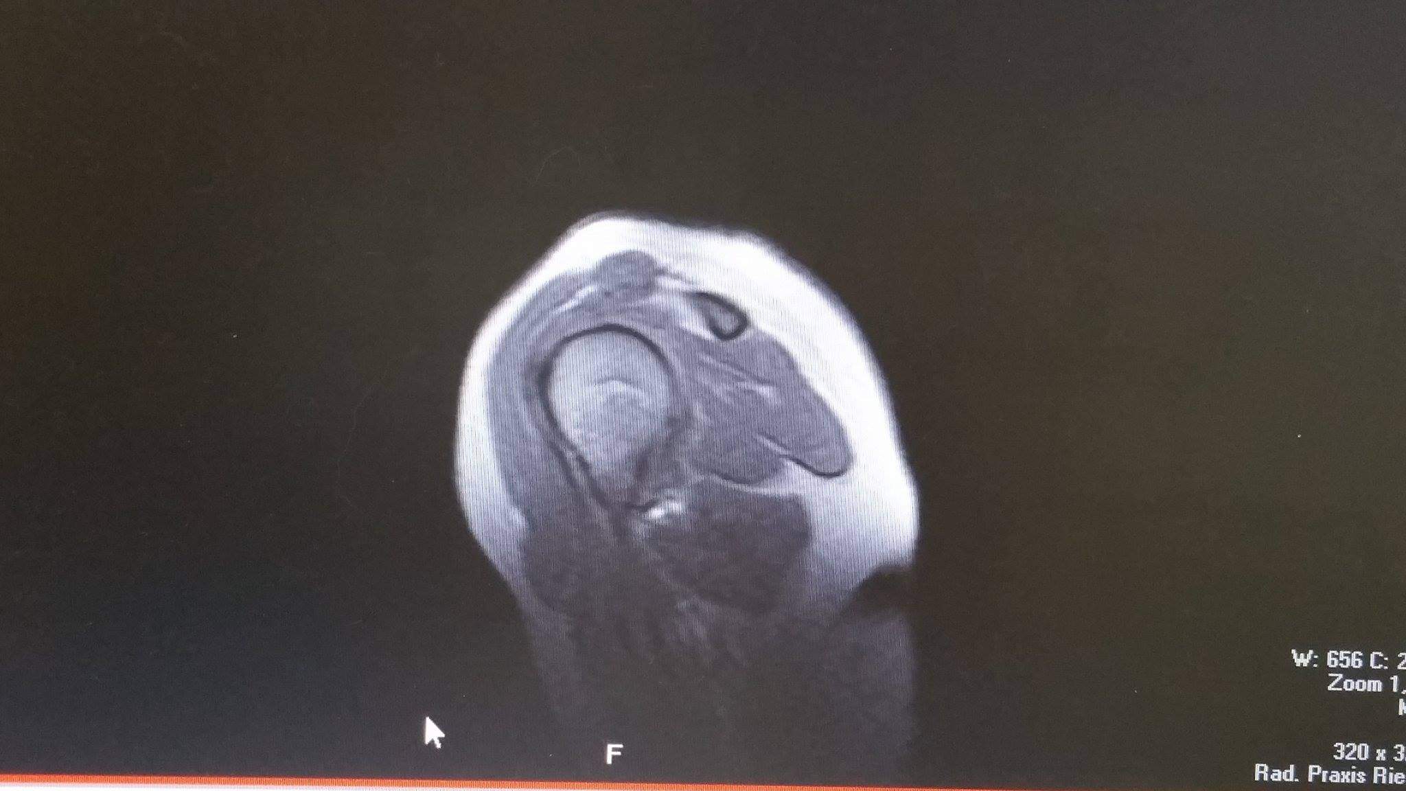 MRT Bilder meiner Schulter , ich bitte um Aufklärung ? (Schultergelenk) MRT Bilder meiner Schulter , ich bitte um Aufklärung ? (Schultergelenk)