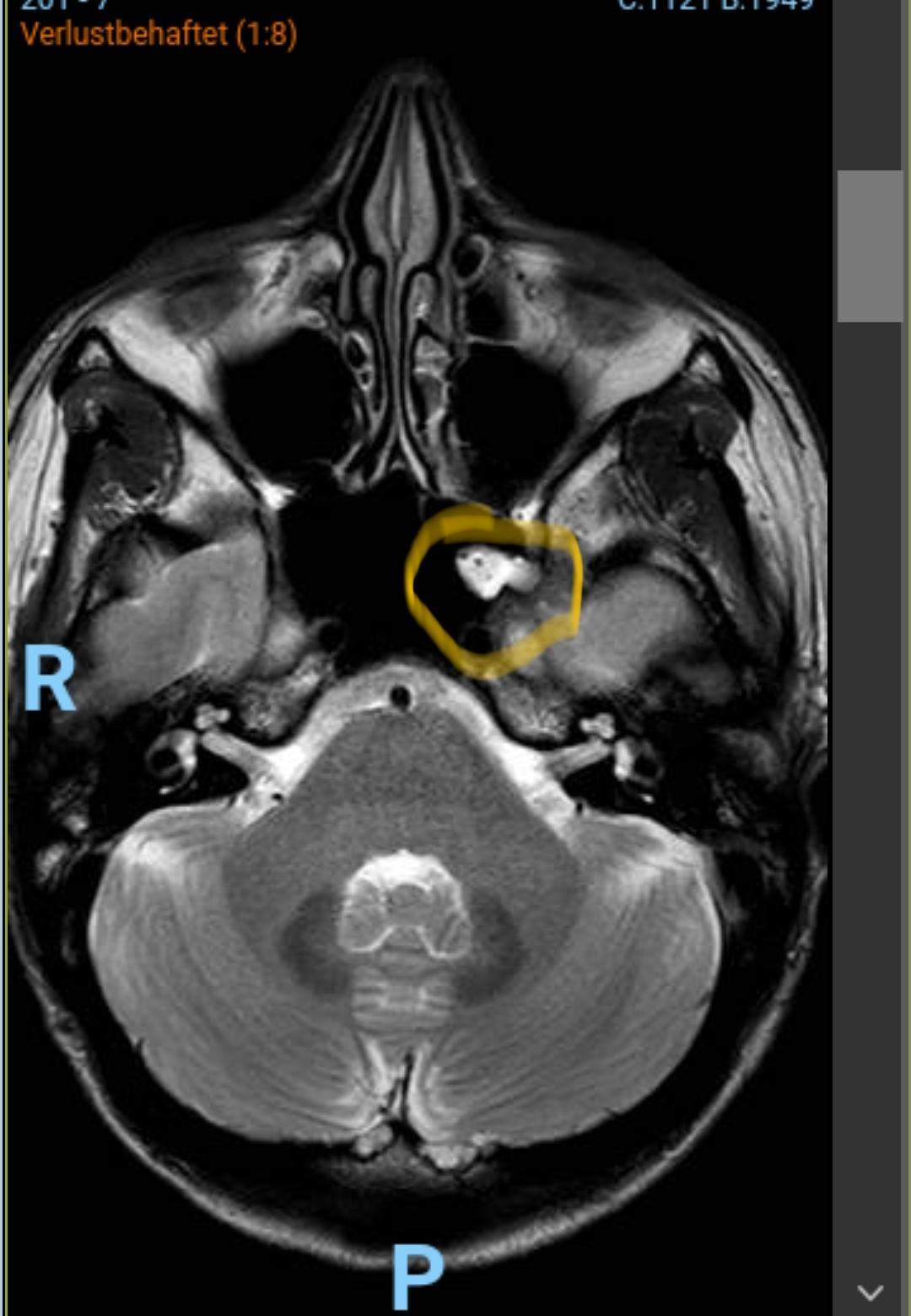 Mrt Kopf, was ist das weisse? (Radiologie)