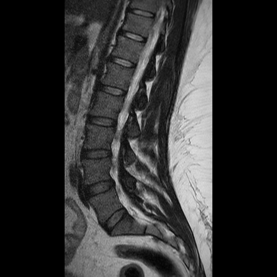MRT LWS? (Radiologie)