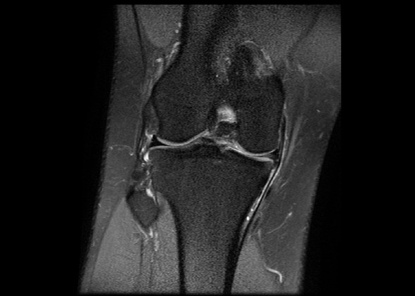 Mrt Rechte Kniegelenk Befund Bitte Ubersetzen Mrt Rechte Kniegelenk Befund Bitte Ubersetzen