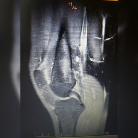Mrt Vom Linken Knie Jemand Erfahrung Mit Bild Auswerten Befund Mrt Vom Linken Knie Jemand Erfahrung Mit Bild Auswerten Befund