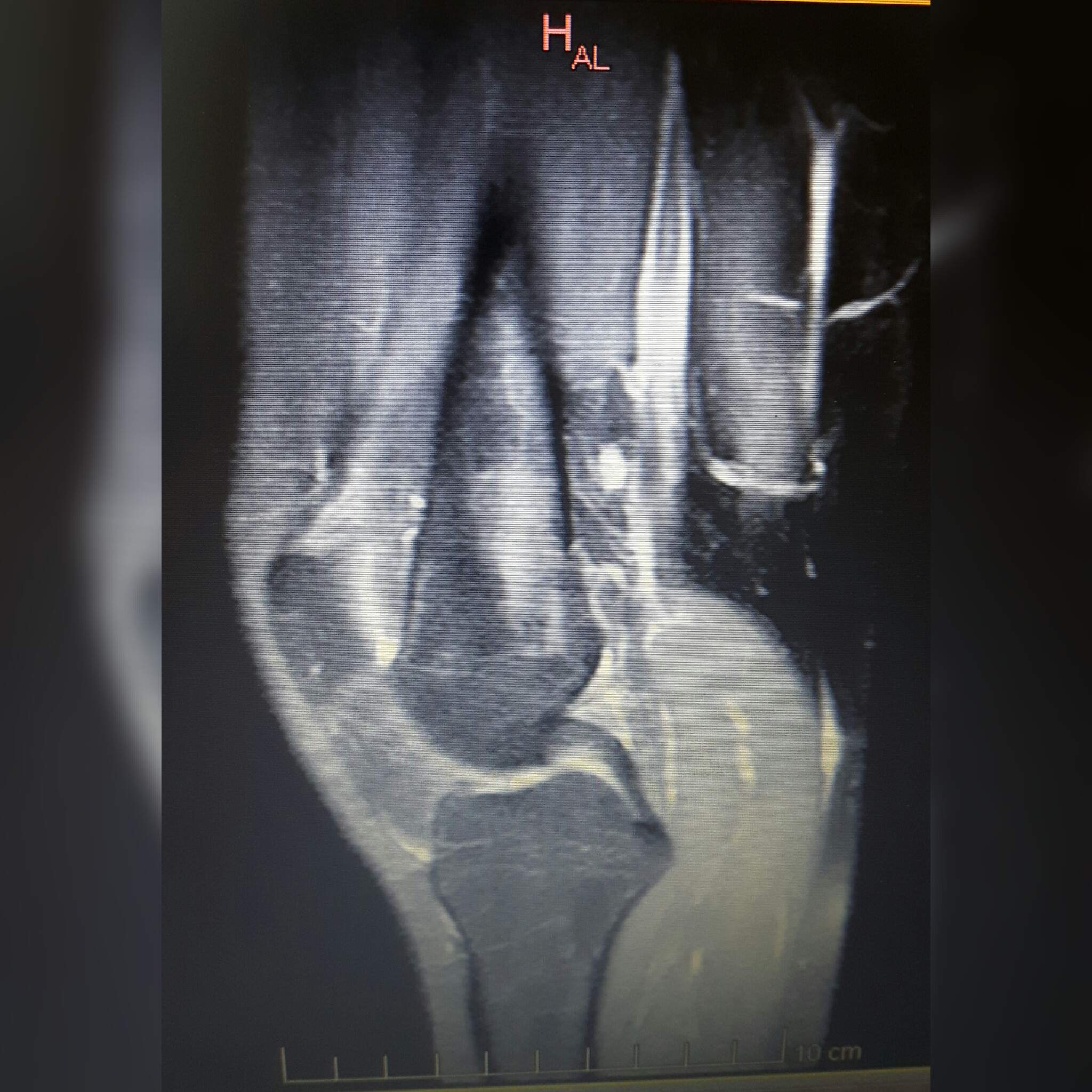 MRT vom linken Knie jemand Erfahrung mit Bild auswerten? (Befund)