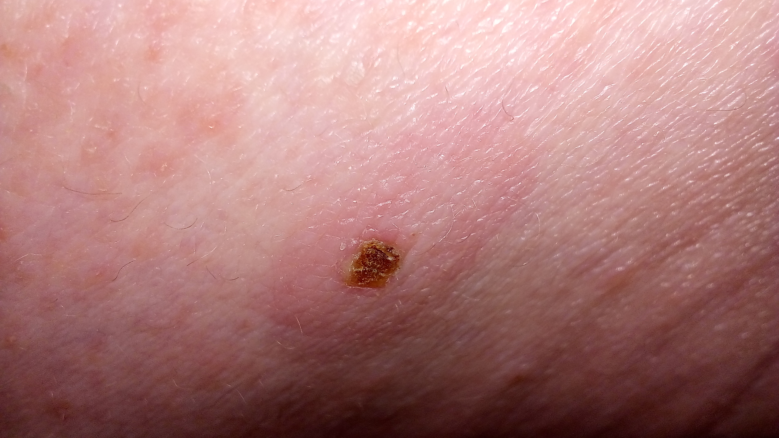 Download Pickel Unter Der Haut Schmerzen Pics