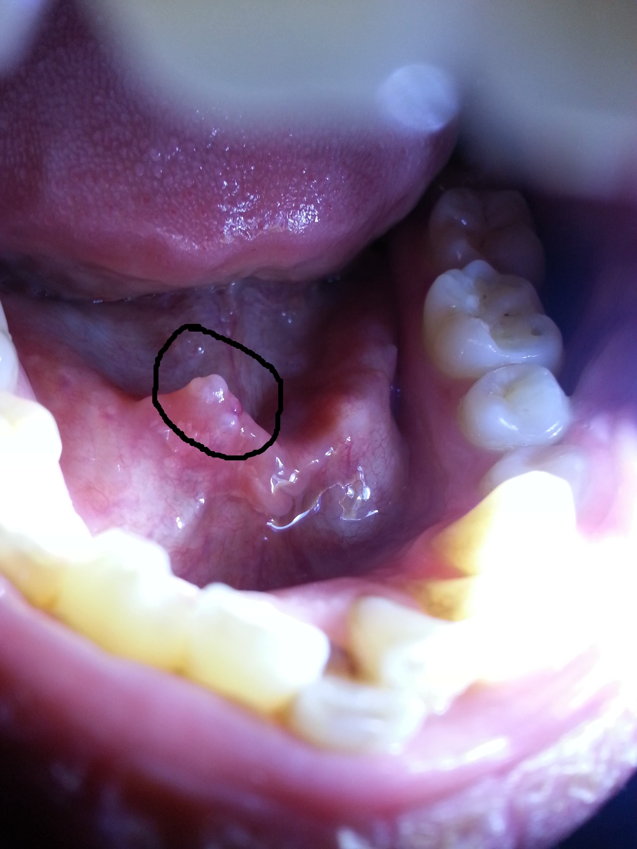 Smiley Der Zunge Rausstreckt / Pickel auf der zunge kraterförmig normal oder nicht pickel im mund ausdrücken