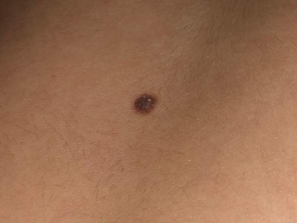 Muss eine größere Schnittwunde(Muttermal Entfernung) als geplant was Muss eine größere Schnittwunde(Muttermal Entfernung) als geplant was