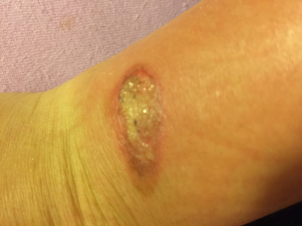 Foto 1 - (Wunde, Verbrennung, Sepsis)