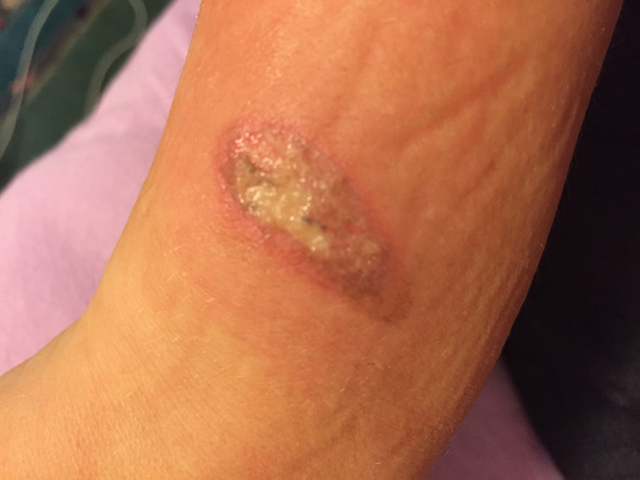 Foto 2 - (Wunde, Verbrennung, Sepsis)