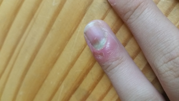 Muss ich den Fingernagel rausziehen?
