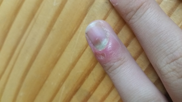 muss ich den fingernagel rausziehen fingernagel nagelbett