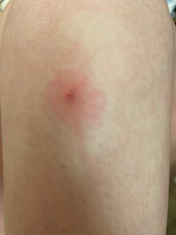 - (Allergie, Insektenstichallergie )