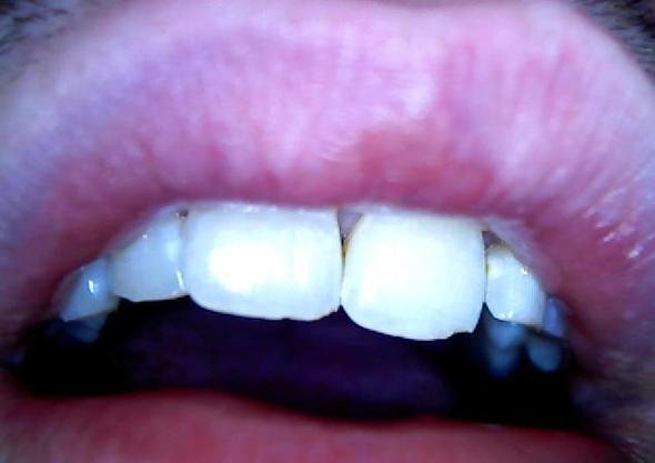 Muss man etwas abgebrochene Zähne behandeln (knirschen)?