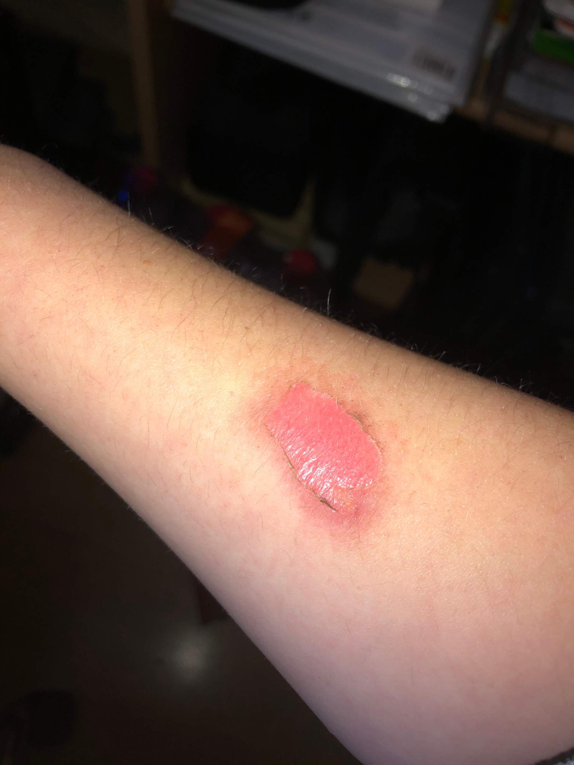 Muss man zum Arzt und wird das eine Narbe? (Haut, Wunde, Narben)