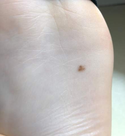 Fußsohle leberfleck Wegen Kosten:1