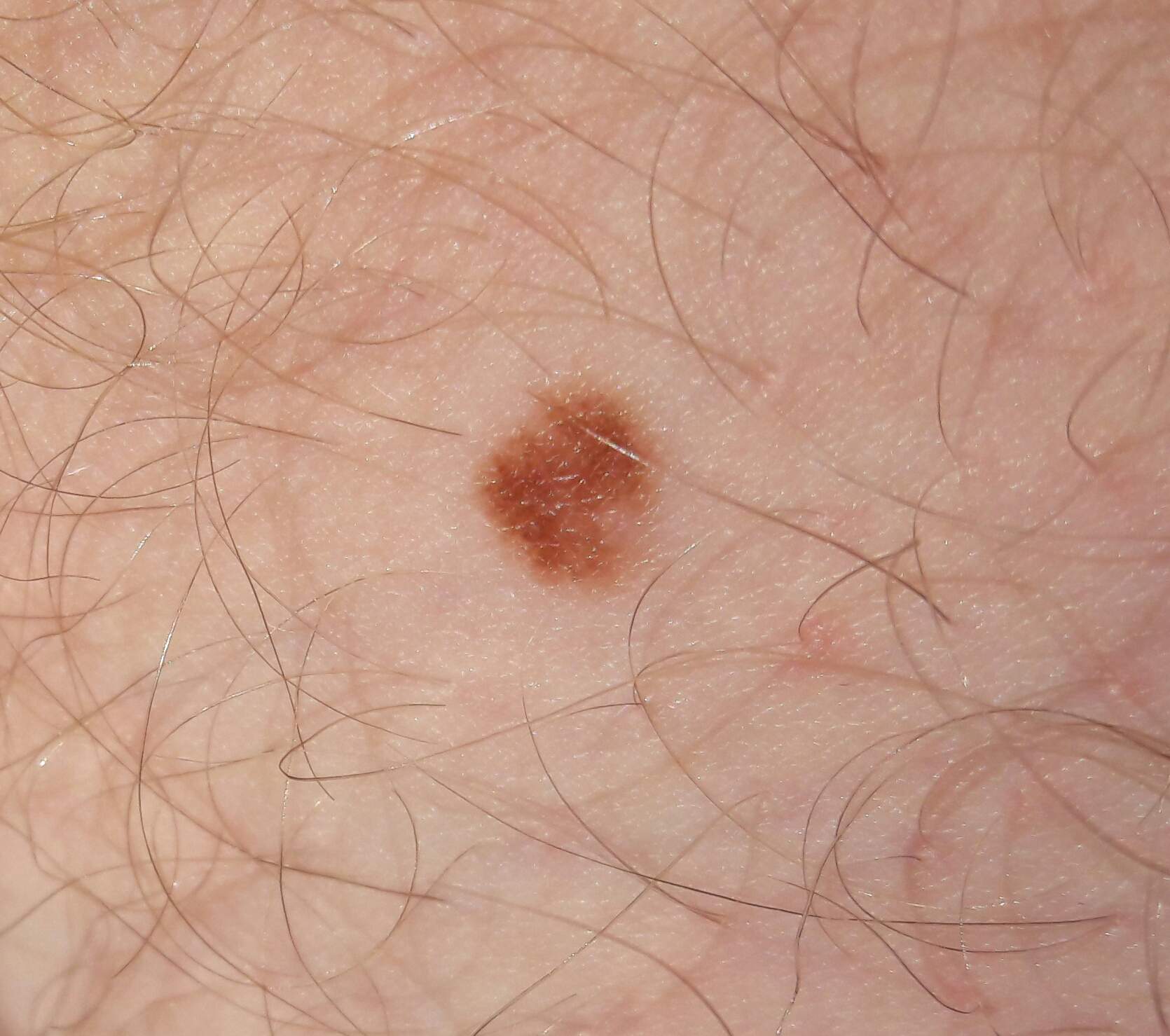 Muttermal verdächtig? (Haut)