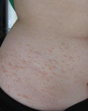 Der Ausschlag an der Hüfte - (Haut, Ausschlag, Dermatologie)