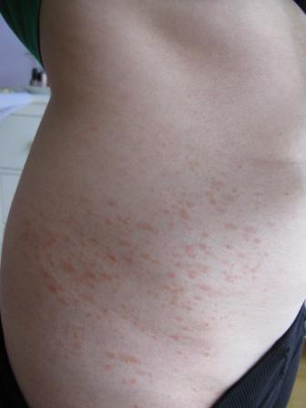 Der Ausschlag an der Hüfte - (Haut, Ausschlag, Dermatologie)