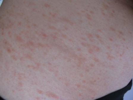 Der Ausschlag an der Hüfte - (Haut, Ausschlag, Dermatologie)