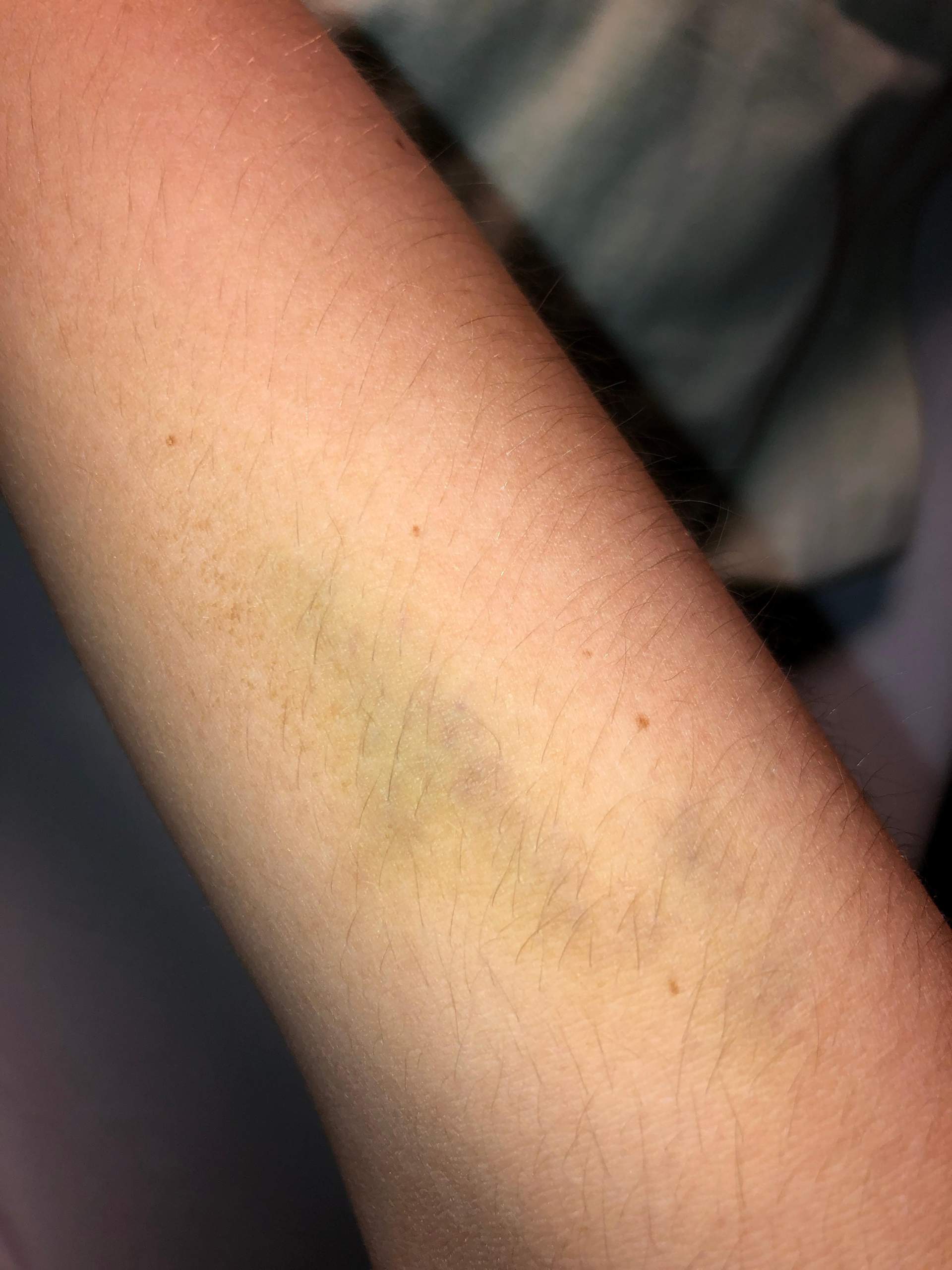 Nach Blutabnahme Unterarm blau? (Schmerzen) Nach Blutabnahme Unterarm blau? (Schmerzen)