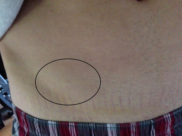 Nach Leistenangiografie Leiste Geschwollen Leistenbruch Schwellung Nach Leistenangiografie Leiste Geschwollen Leistenbruch Schwellung