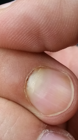 nach nagelbettentzundung lost sich der nagel vom nagelbett auf nagelpilz nagelpflege