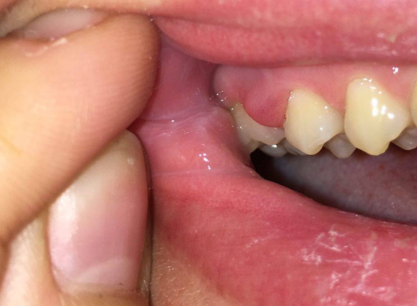 Zahnfleischschwellung mit Eiter - (Schwellung, Zahnfleisch, Eiter)