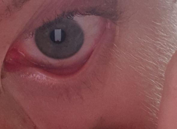 Nach Schlaf Rote Augen Augenarzt Nach Schlaf Rote Augen Augenarzt