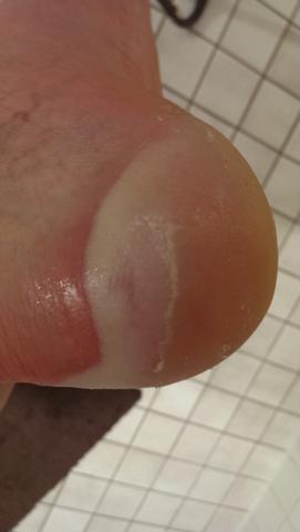 nach dem duschen - (Ferse, Hautkrankheit Fuß)