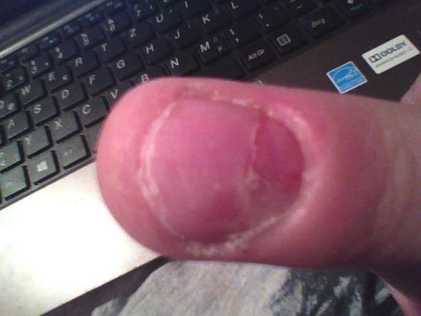 kaputter nagel - (Schmerzen, nägel, Fingernägel)