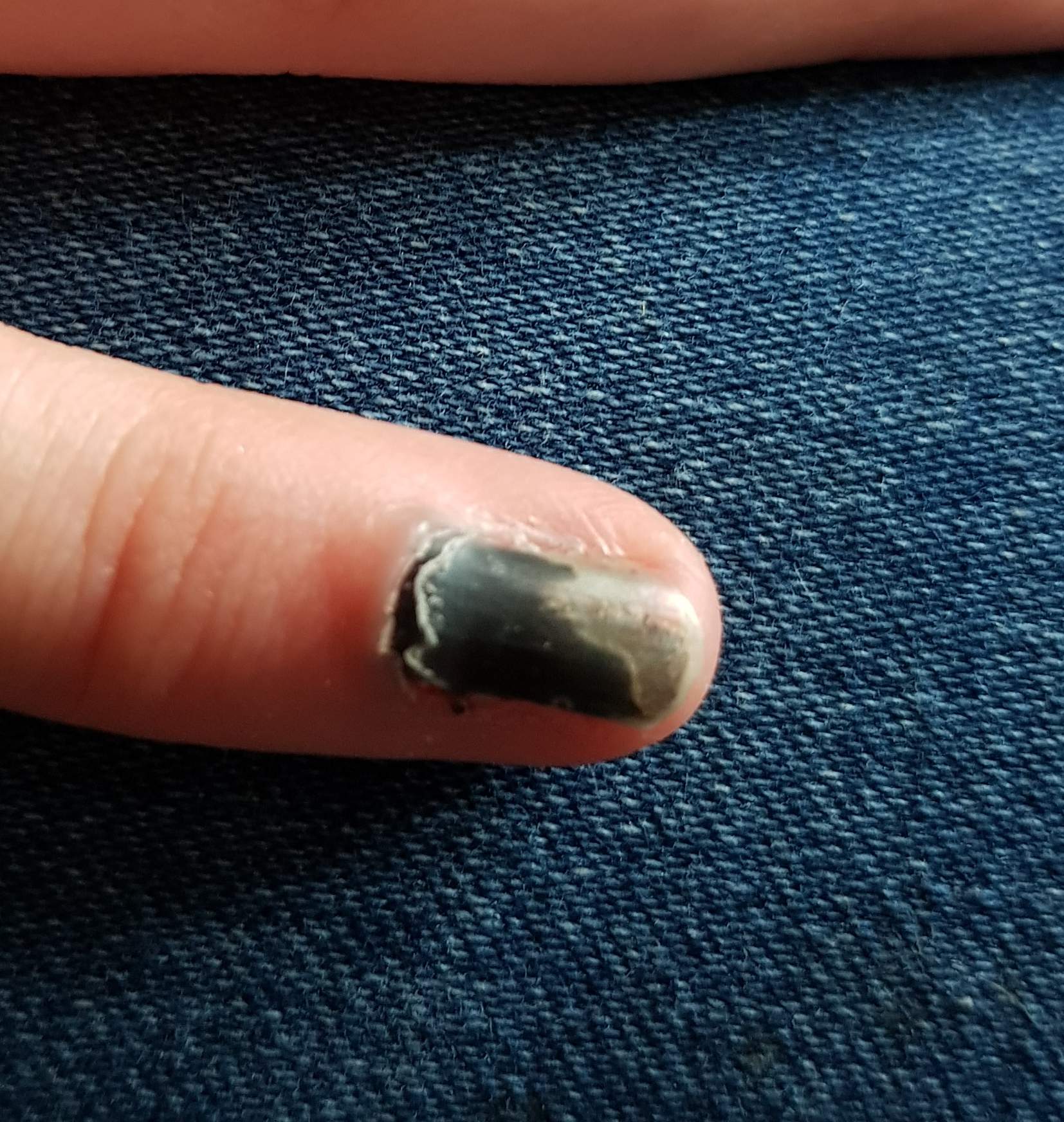 nagel nach quetschung fingernagel