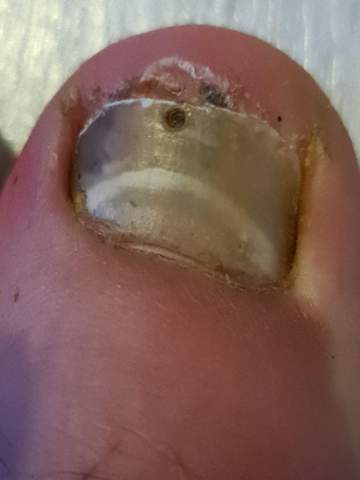 Nagel Verfarbt Was Ist Das Zeh Nagel Nagel Verfarbt Was Ist Das Zeh Nagel