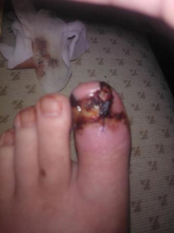 So sieht mein Fuß  jetzt aus - (Schmerzen, Nagelbettentzündung)