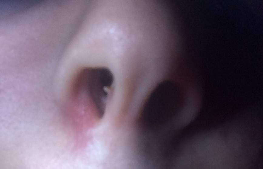 Nase Geschwollen Was Tun Schwellung Hno Nase Geschwollen Was Tun Schwellung Hno