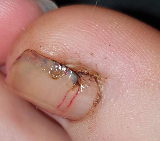 Neuer Zehennagel Unter Altem Schmerzt Schmerzen Laserbehandlung Neuer Zehennagel Unter Altem Schmerzt Schmerzen Laserbehandlung