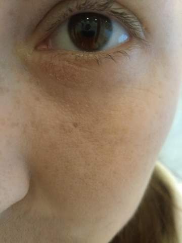 Neurodermitis Oder Nur Trockene Haut Augen Medizin Dermatologie